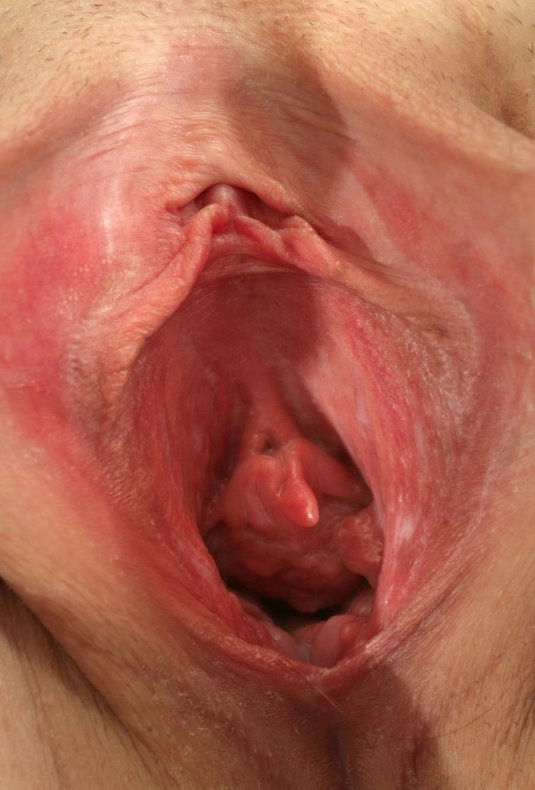 Атрофический фарингит