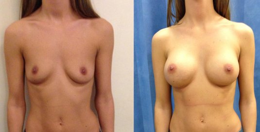 Голые сиськи в разные стороны