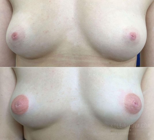 Женская грудь без ореолов