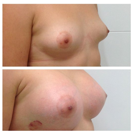 Увеличение груди голые