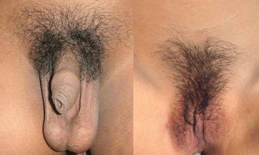 Оволосение женского лобка