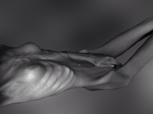 Анорексия ню