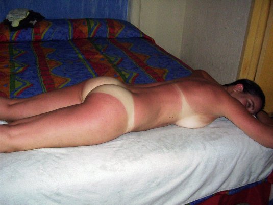 Обгорела на солнце