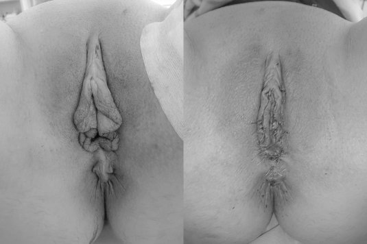 Резекция малых половых губ (лабиопластика)