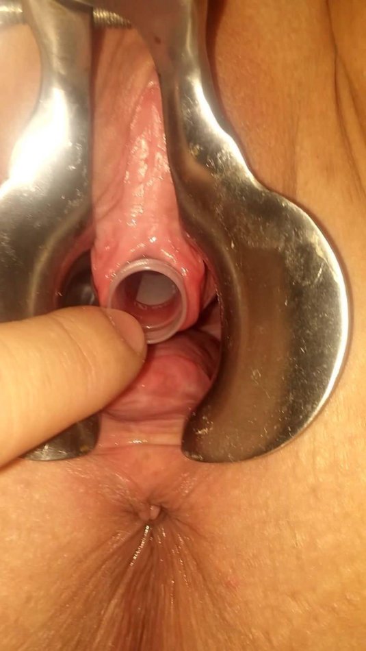 Эрозии шейки матки