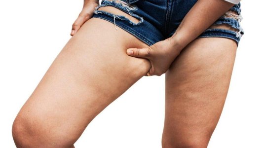 Целлюлит на внутренней стороне бедра