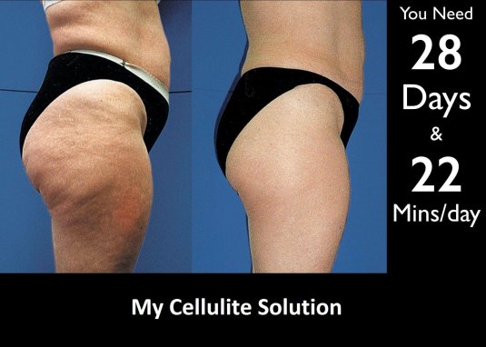 Лазерный липолиз целлюлит