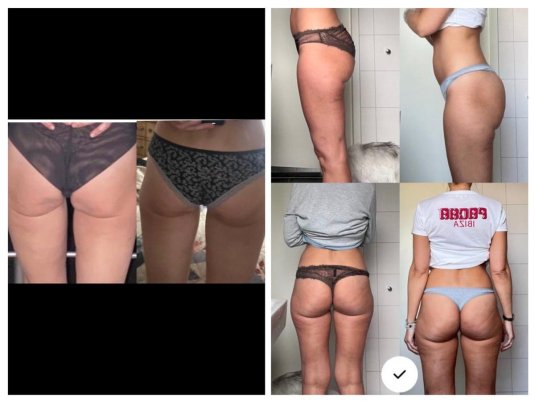 До и после антицеллюлитного массажа