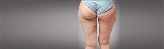 Липодистрофия целлюлит