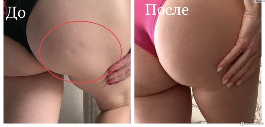 Антицеллюлитный массаж до и после