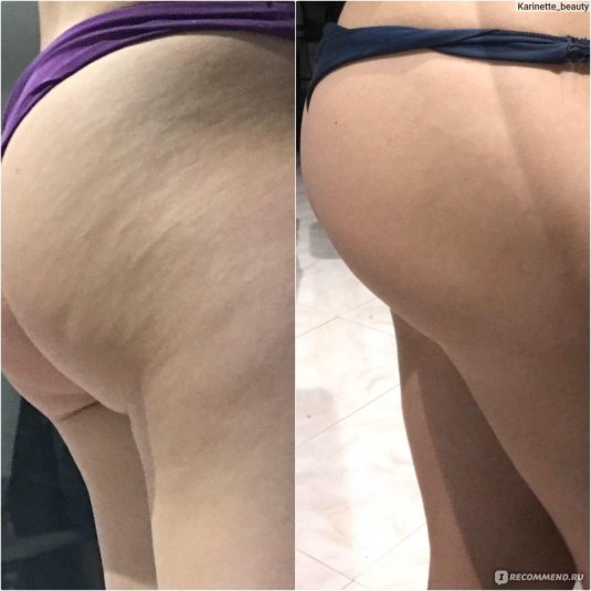 До и после антицеллюлитного массажа
