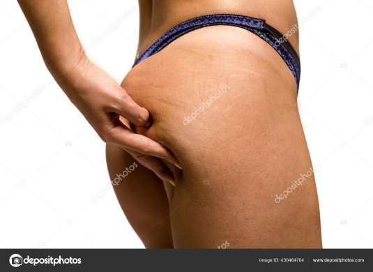 Растяжки и целлюлит