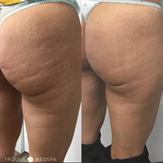 Голые задницы с целлюлитом