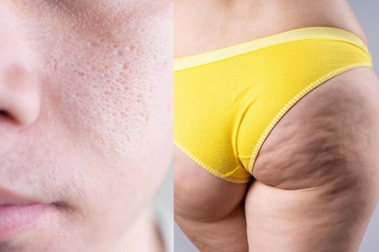 Ожирение ягодиц и бедер