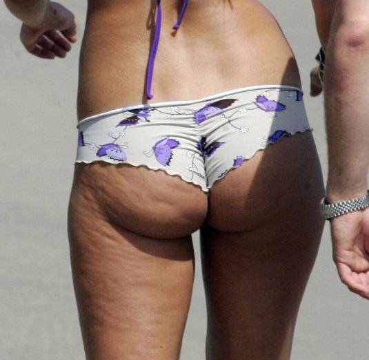 Липодистрофия целлюлит