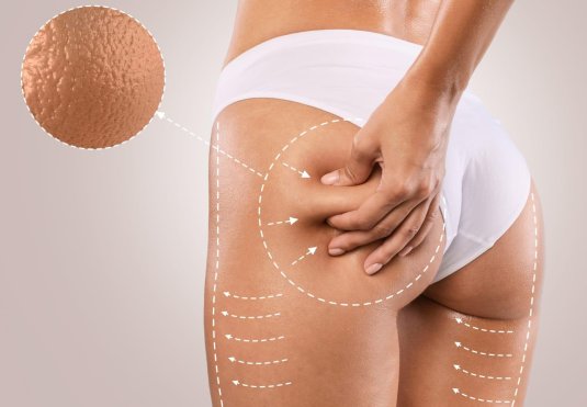 Озонотерапия против целлюлита
