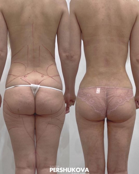 Липофилинг ягодиц