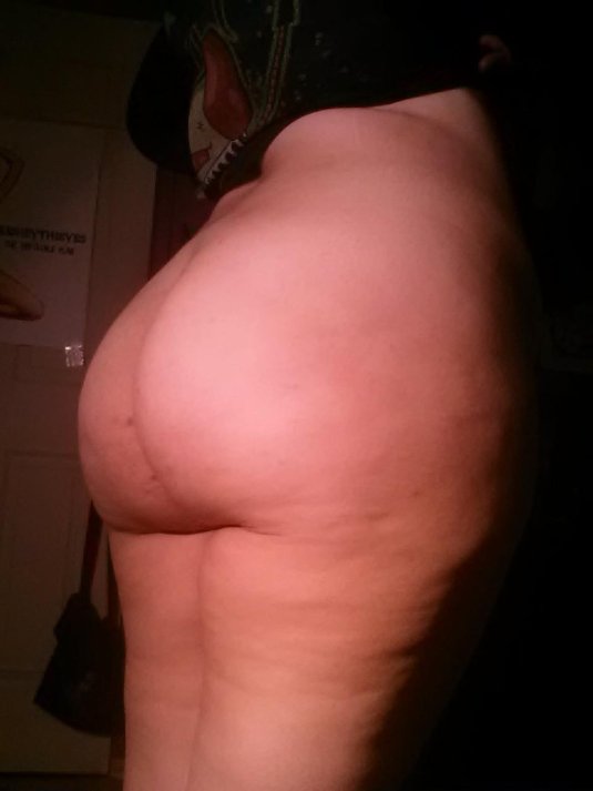 Липодистрофия целлюлит