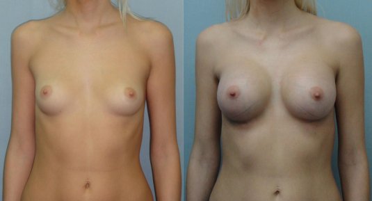Увеличение груди