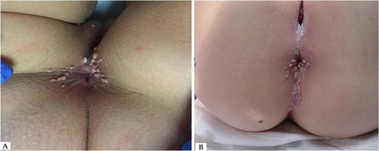 Анус до и после отбеливания