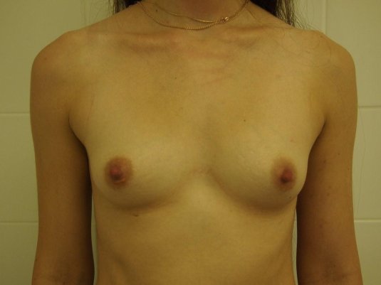 Воронкообразная деформация грудной клетки