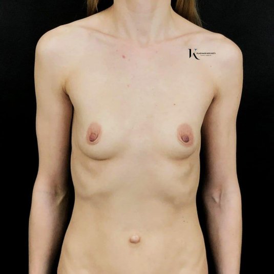 Пластика груди