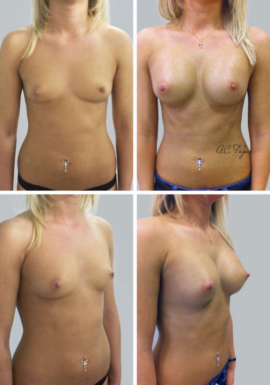 Пластика груди