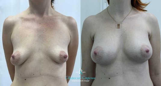 Увеличение груди
