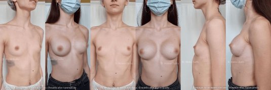 Операция по увеличению груди