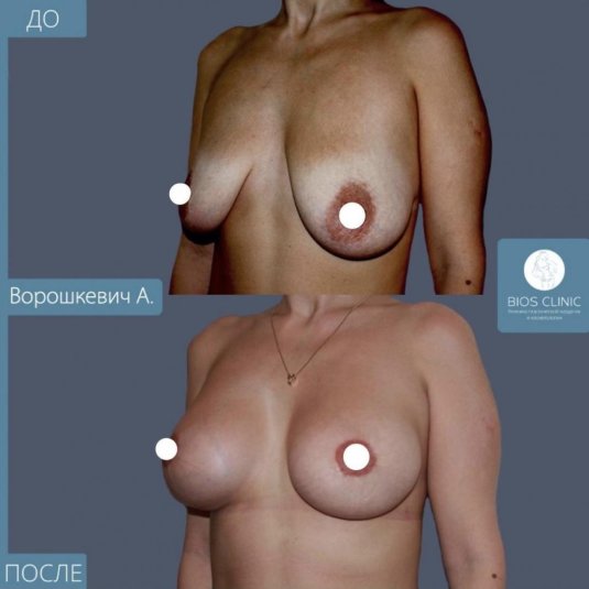 Анатомические импланты