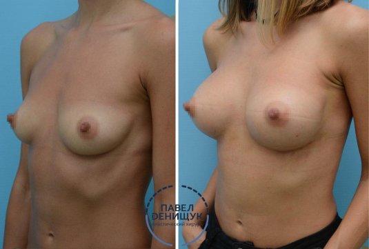 Пластика груди