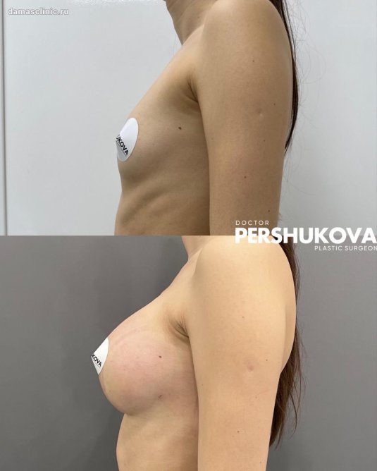 Коррекция груди без имплантов