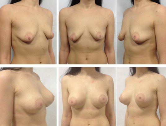 Каплевидная грудь