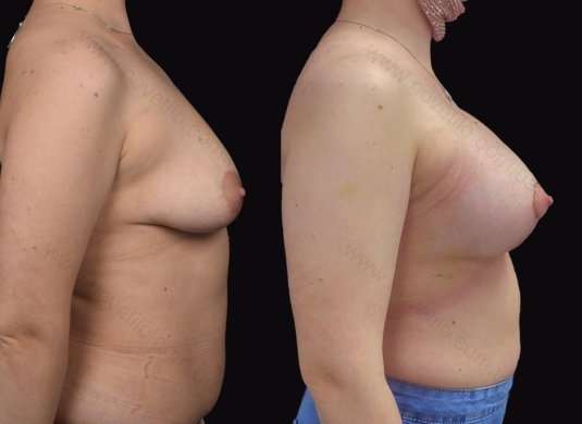 Пластика груди