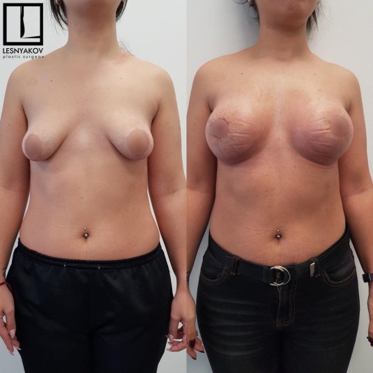 Тубулярная грудь