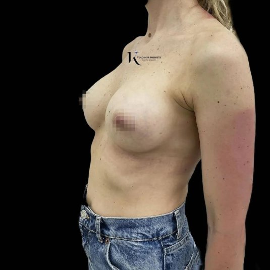 Пластика груди