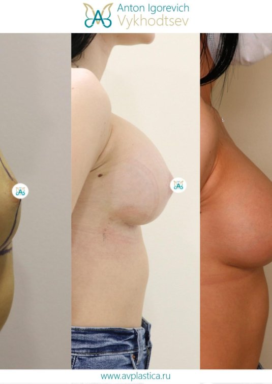 Увеличение груди