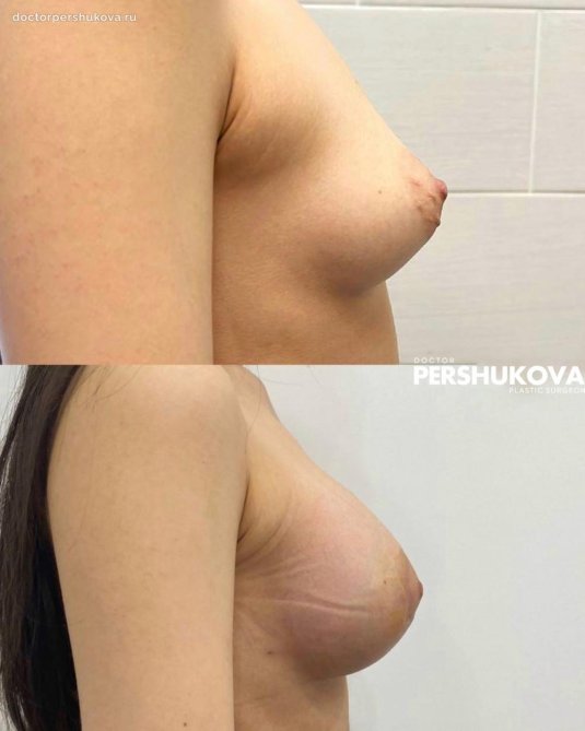 До и после увеличения груди