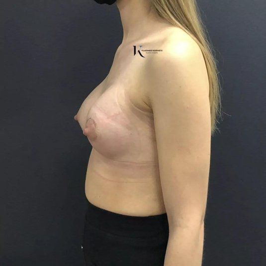 Пластика груди