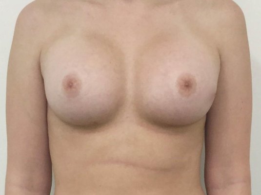 Маммопластика каплевидные