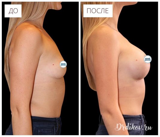 Пластика груди