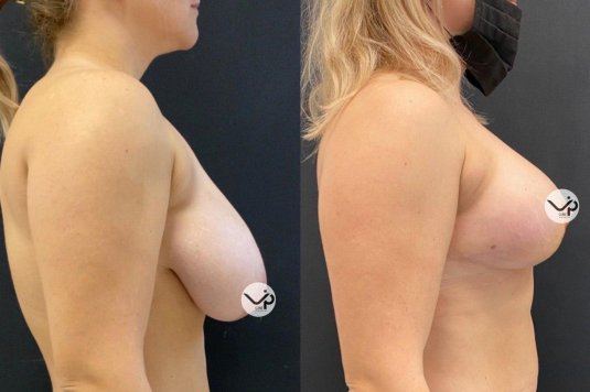 Мастопексия молочных желез