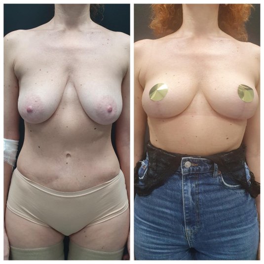 Якорная мастопексия без имплантов