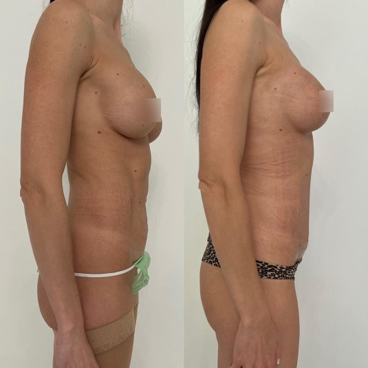 Подтяжка без имплантов