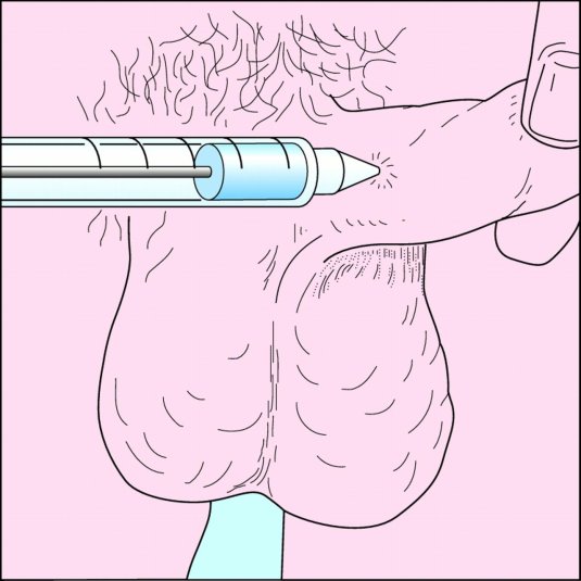 Инъекции в член